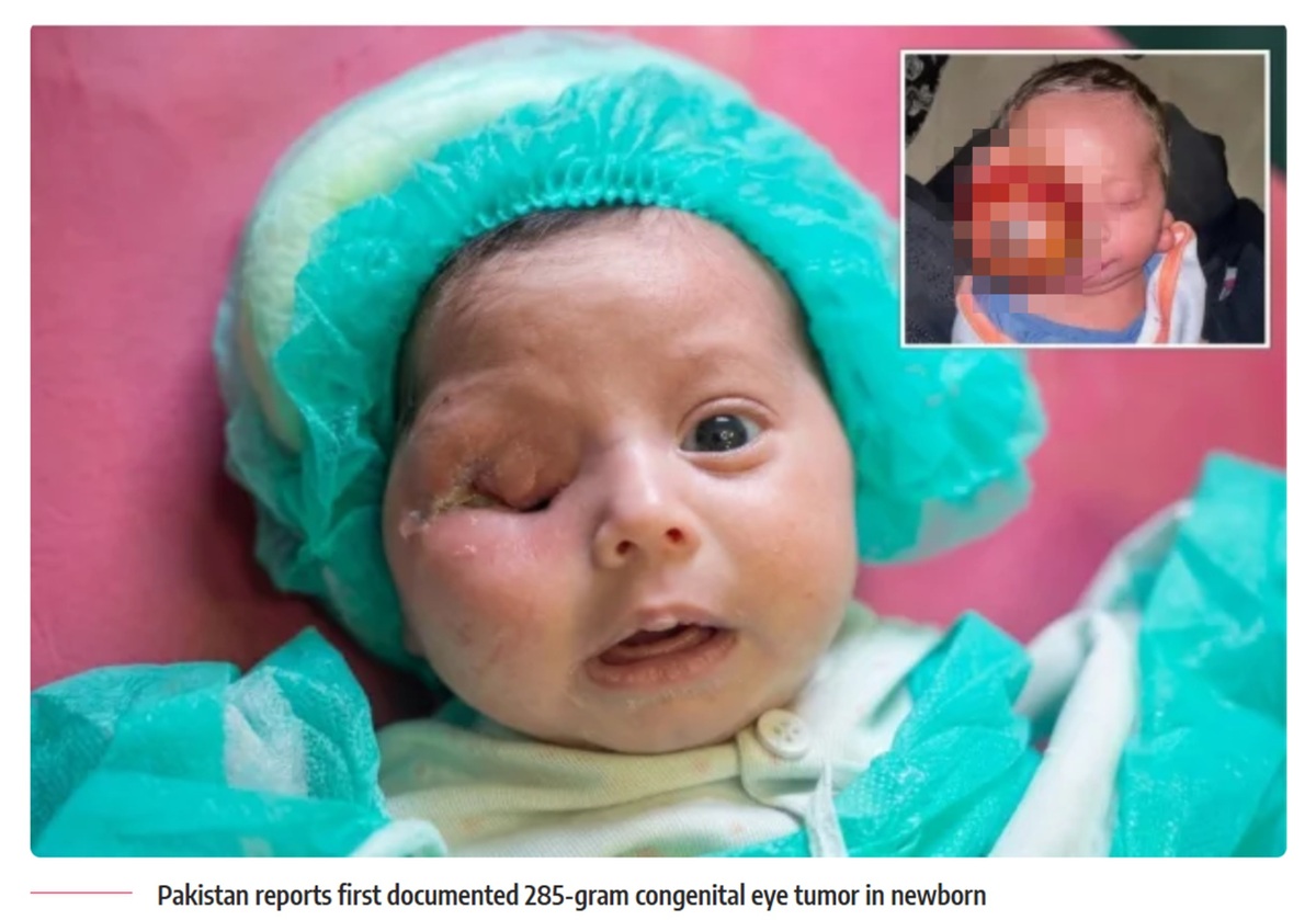 A Race Against Time: Al-Shifa Trust Performs Pakistan’s First Successful Surgery on a Three-Day-Old Newborn with a Massive Congenital Eye Tumor.
