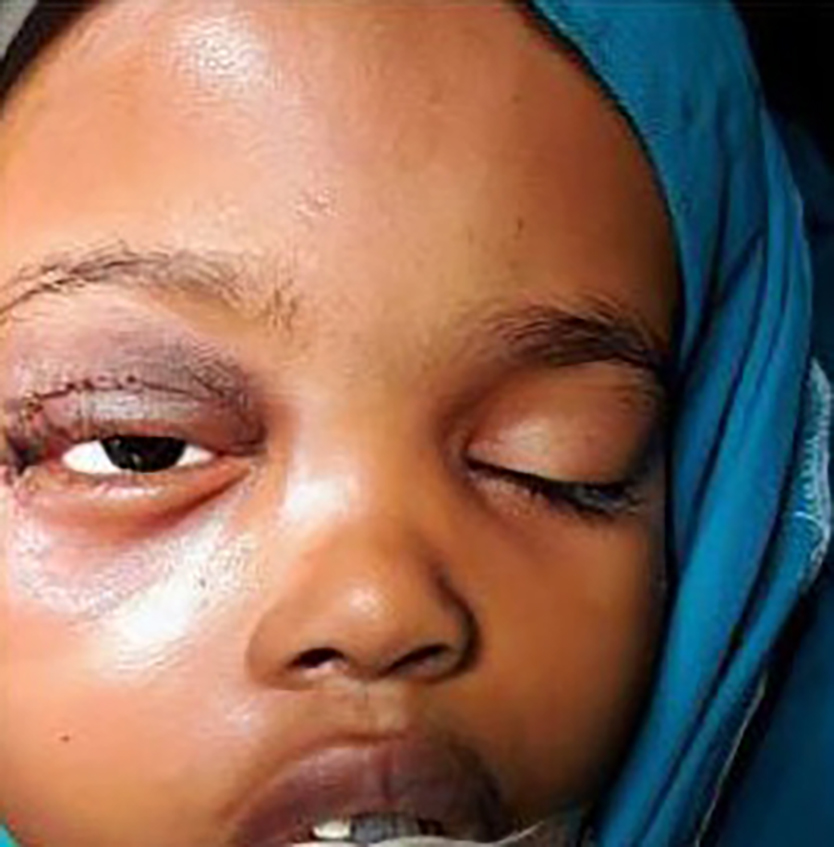 A Second Chance at Life: Al-Shifa Trust Save Nimoh’s Future